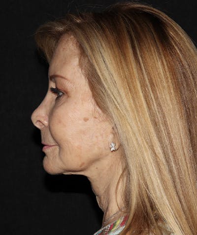 Facelift Before & After Gallery - Patient 121258980 - Image 5