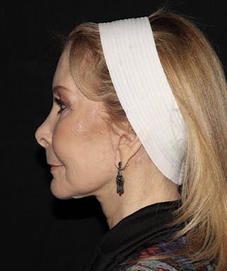 Laser Resurfacing Before & After Gallery - Patient 121258988 - Image 6