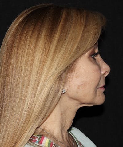 Laser Resurfacing Before & After Gallery - Patient 121258988 - Image 7
