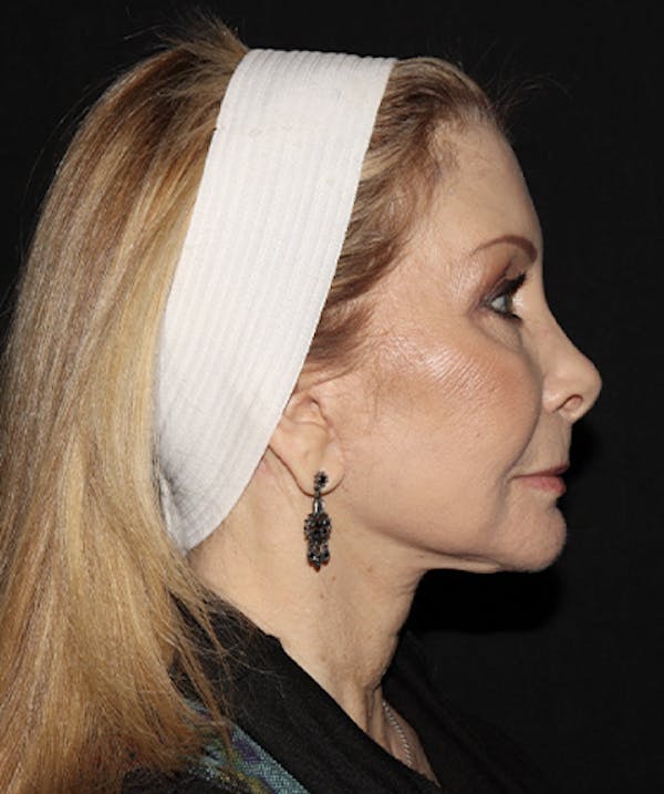 Laser Resurfacing Before & After Gallery - Patient 121258988 - Image 8