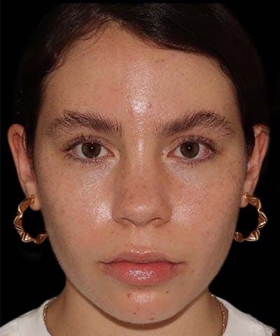 Rhinoplasty Before & After Gallery - Patient 121619815 - Image 1