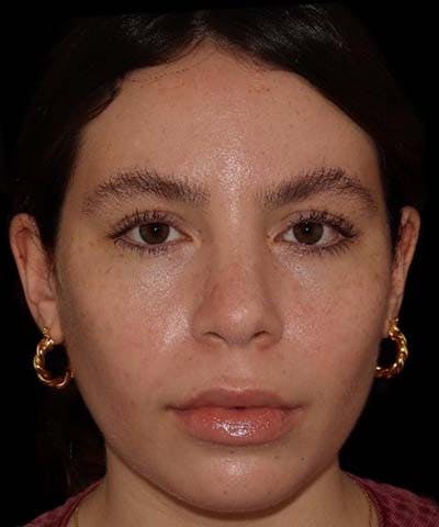 Rhinoplasty Before & After Gallery - Patient 121619815 - Image 2