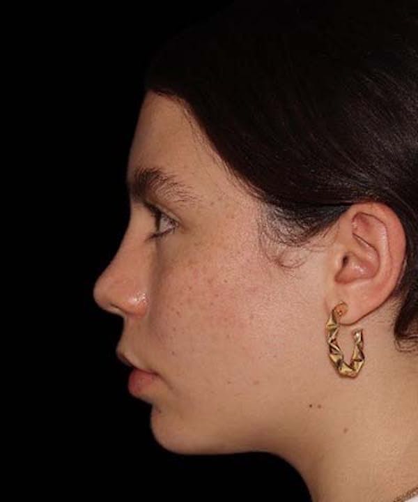 Rhinoplasty Before & After Gallery - Patient 121619815 - Image 3