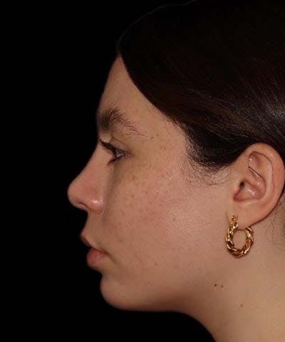 Rhinoplasty Before & After Gallery - Patient 121619815 - Image 4