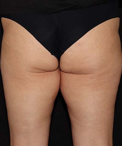 Profound Before & After Gallery - Patient 101411633 - Image 3