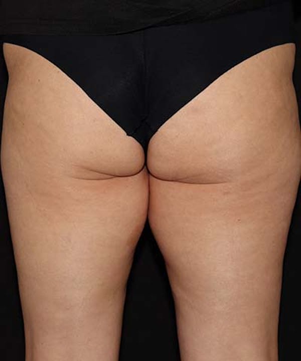 Profound Before & After Gallery - Patient 101411633 - Image 3