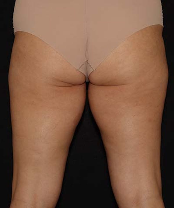 Profound Before & After Gallery - Patient 101411633 - Image 4