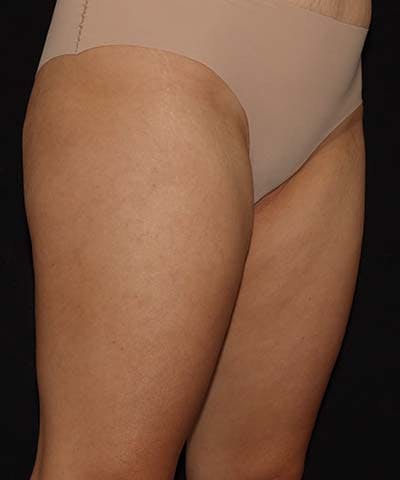 Profound Before & After Gallery - Patient 101411633 - Image 2