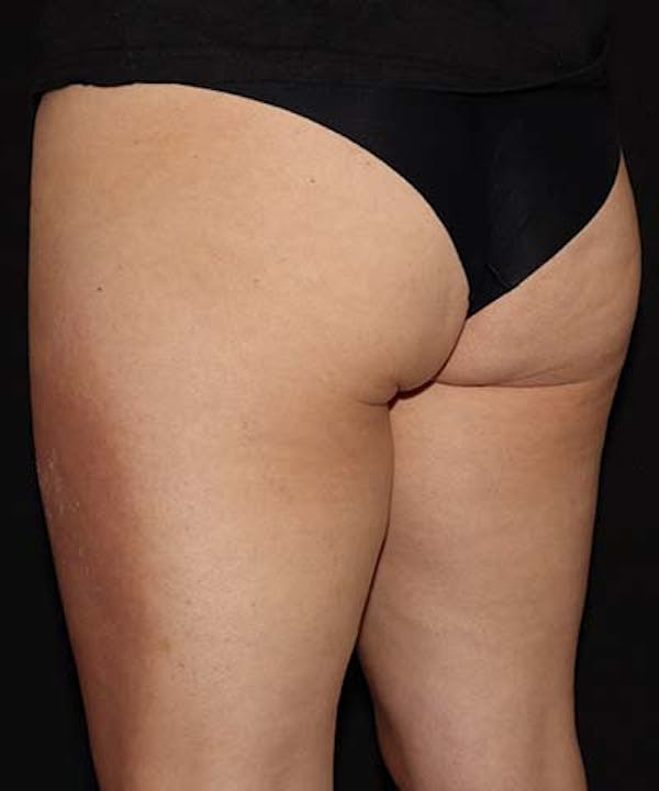 Profound Before & After Gallery - Patient 101411633 - Image 5
