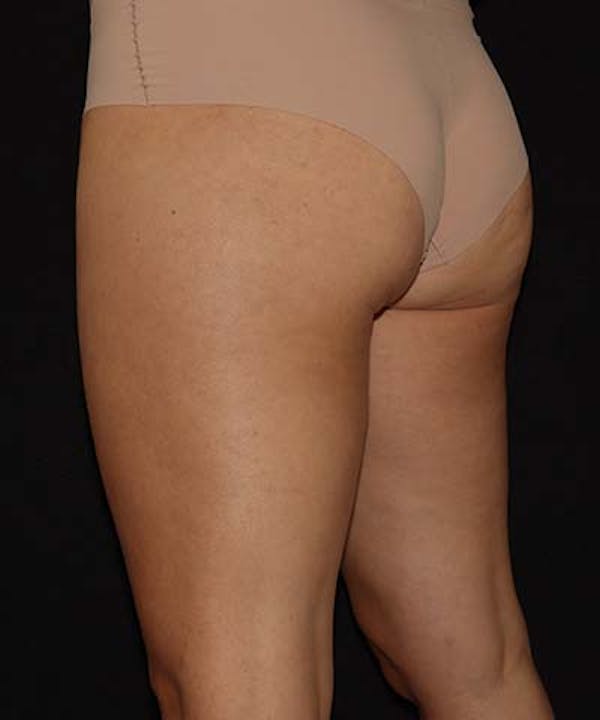 Profound Before & After Gallery - Patient 101411633 - Image 6