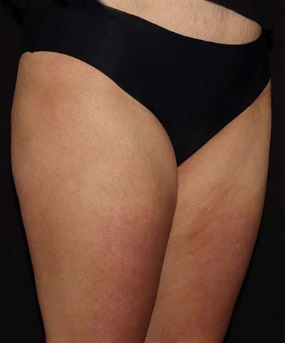 Profound Before & After Gallery - Patient 101411633 - Image 1