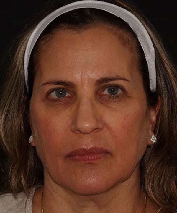 Facetite Before & After Gallery - Patient 121621462 - Image 1
