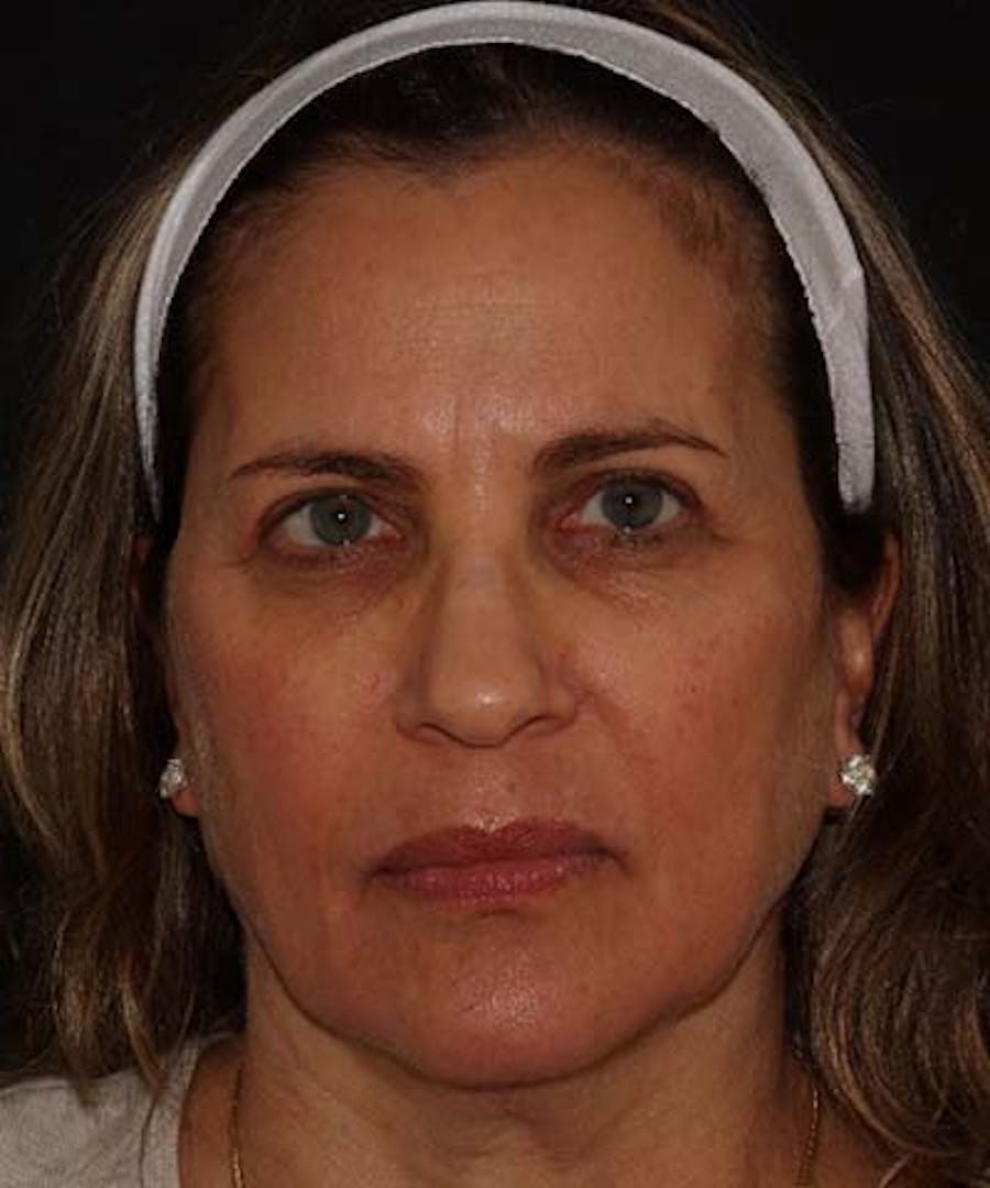 Facetite Before & After Gallery - Patient 121621462 - Image 1