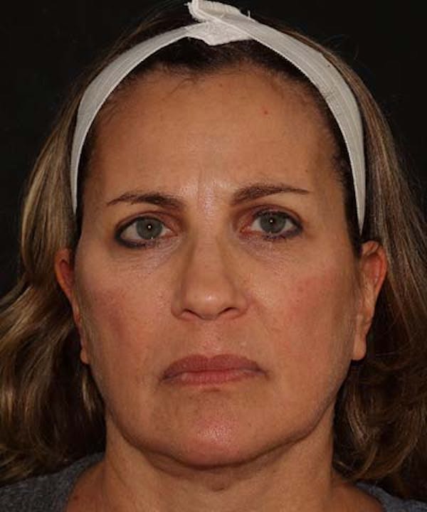 Facetite Before & After Gallery - Patient 121621462 - Image 2