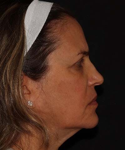 Facetite Before & After Gallery - Patient 121621462 - Image 3