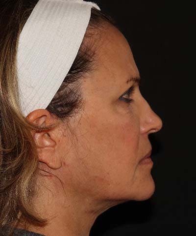 Facetite Before & After Gallery - Patient 121621462 - Image 4