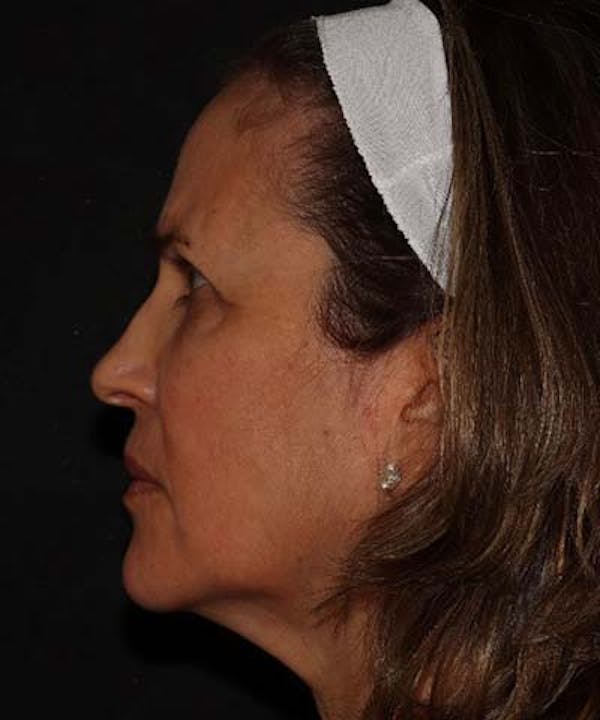 Facetite Before & After Gallery - Patient 121621462 - Image 5