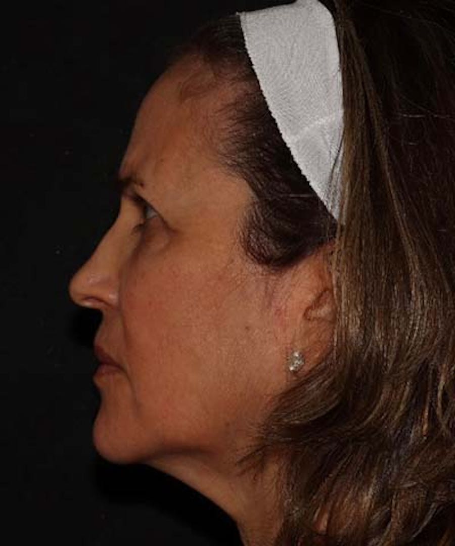Facetite Before & After Gallery - Patient 121621462 - Image 5
