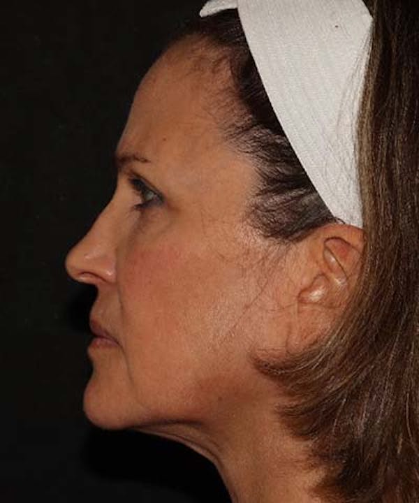 Facetite Before & After Gallery - Patient 121621462 - Image 6