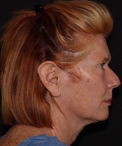  Blepharoplasty Before & After Gallery - Patient 121621524 - Image 5