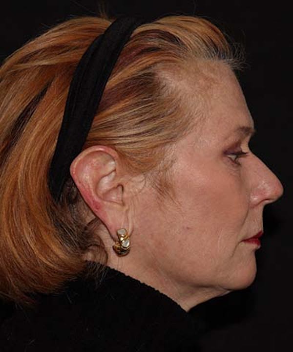  Blepharoplasty Before & After Gallery - Patient 121621524 - Image 6