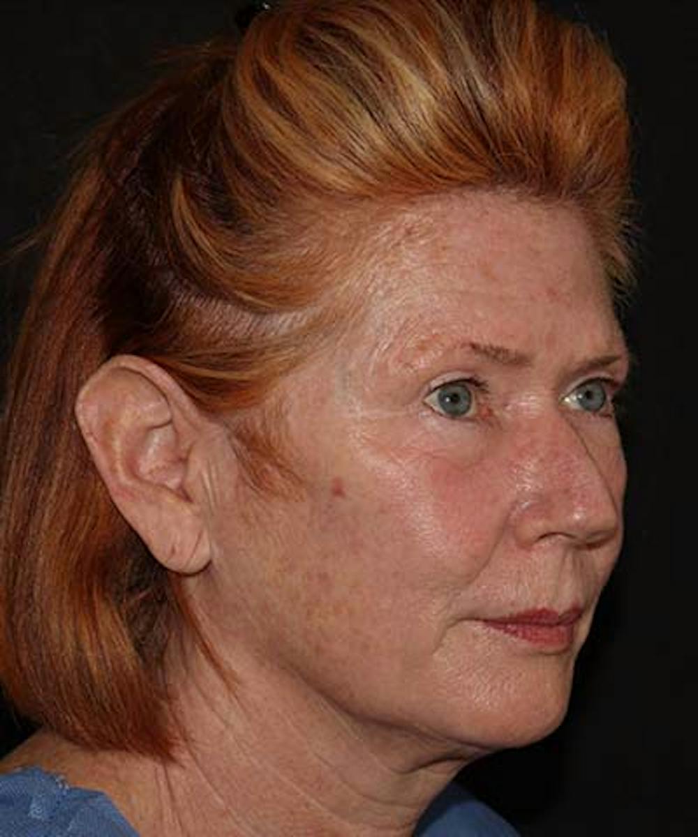  Blepharoplasty Before & After Gallery - Patient 121621524 - Image 3