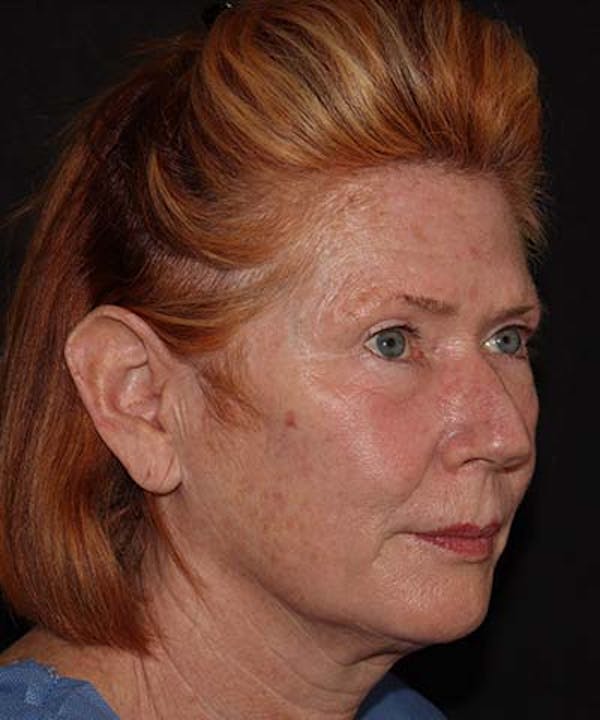  Blepharoplasty Before & After Gallery - Patient 121621524 - Image 3