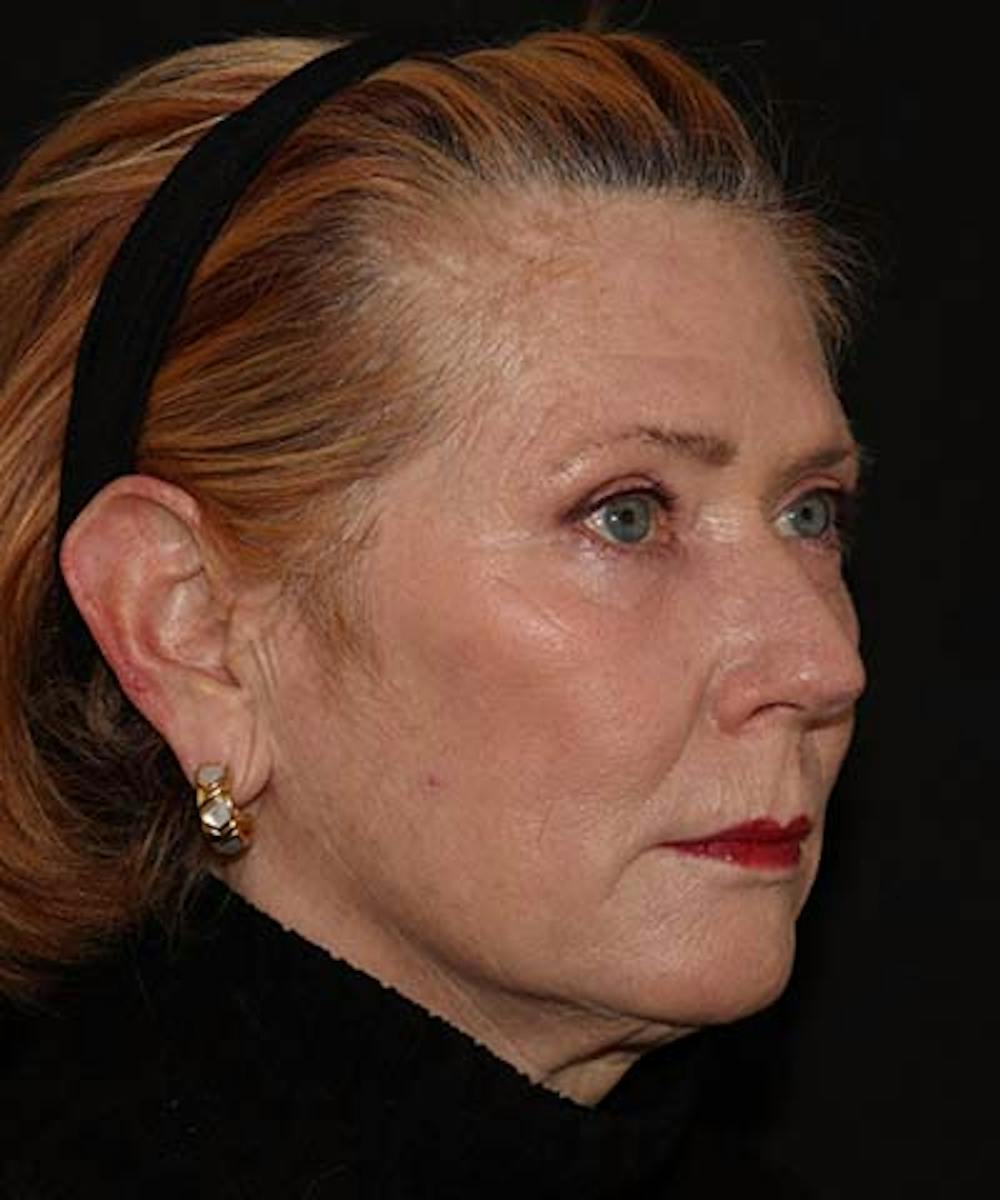 Blepharoplasty Before & After Gallery - Patient 121621524 - Image 4