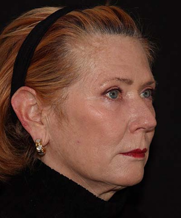  Blepharoplasty Before & After Gallery - Patient 121621524 - Image 4