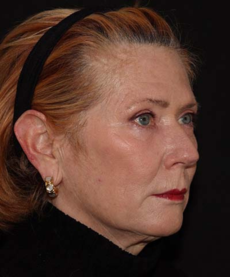  Blepharoplasty Before & After Gallery - Patient 121621524 - Image 4