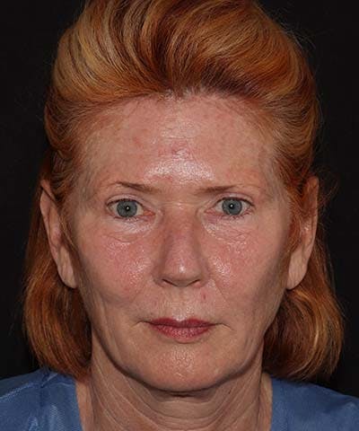 Blepharoplasty Before & After Gallery - Patient 121621524 - Image 1
