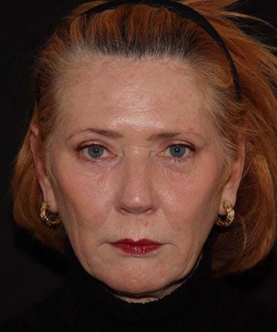  Blepharoplasty Before & After Gallery - Patient 121621524 - Image 2