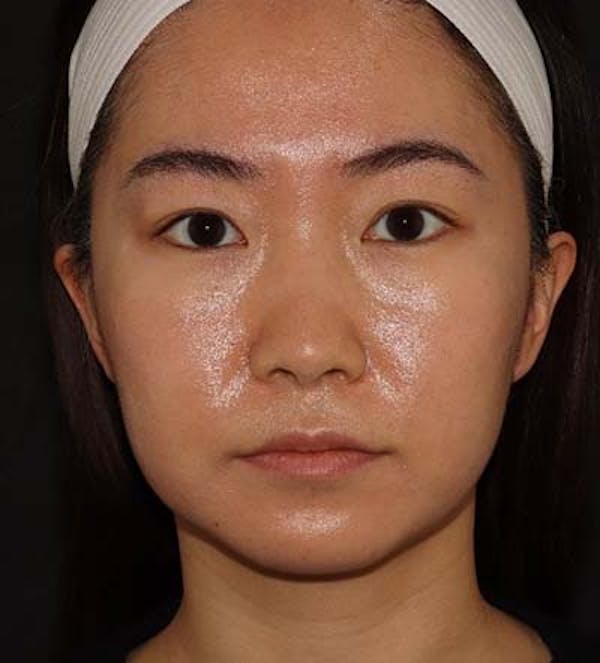 Liquid Rhinoplasty Before & After Gallery - Patient 141186402 - Image 1