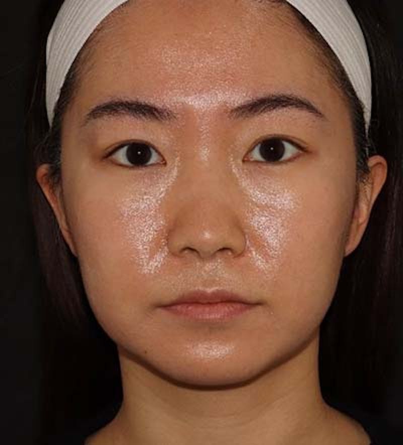Liquid Rhinoplasty Before & After Gallery - Patient 141186402 - Image 1