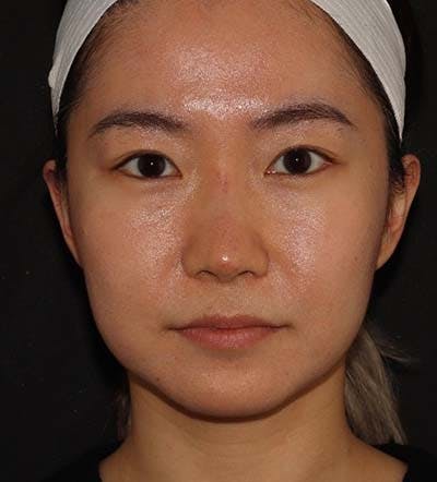 Liquid Rhinoplasty Before & After Gallery - Patient 141186402 - Image 2