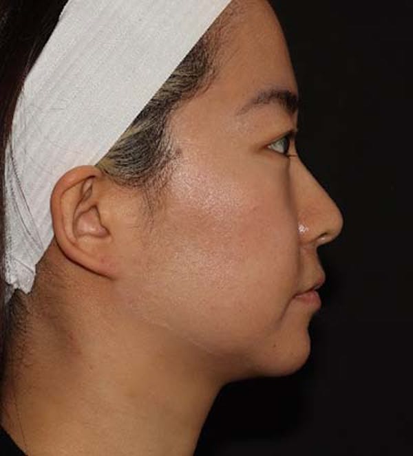 Liquid Rhinoplasty Before & After Gallery - Patient 141186402 - Image 3