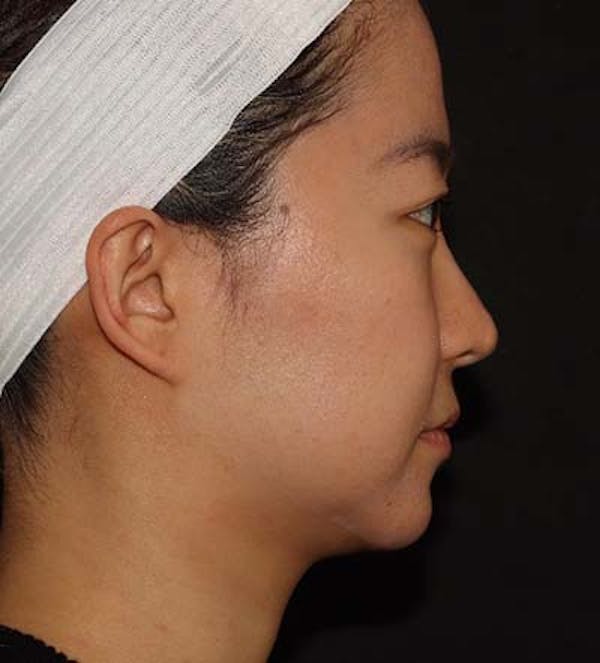Liquid Rhinoplasty Before & After Gallery - Patient 141186402 - Image 4