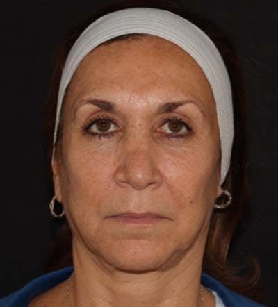 Facelift Before & After Gallery - Patient 121670066 - Image 1