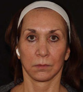 Facelift Before & After Gallery - Patient 121670066 - Image 2