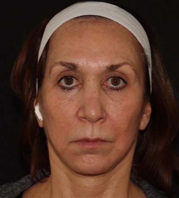 Facelift Before & After Gallery - Patient 121670066 - Image 2