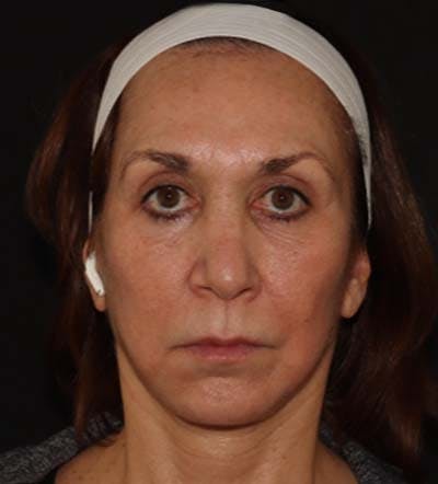 Before and After Eyelid Surgery in Westchester 02