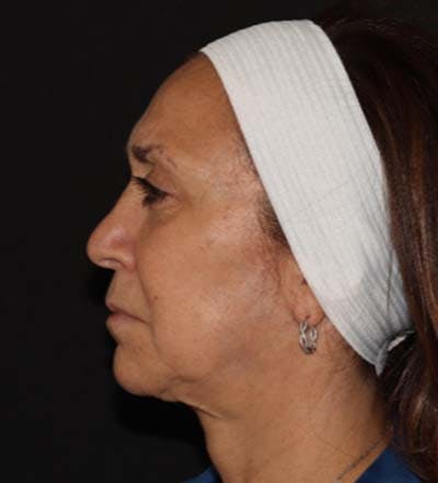 Facelift Before & After Gallery - Patient 121670066 - Image 3