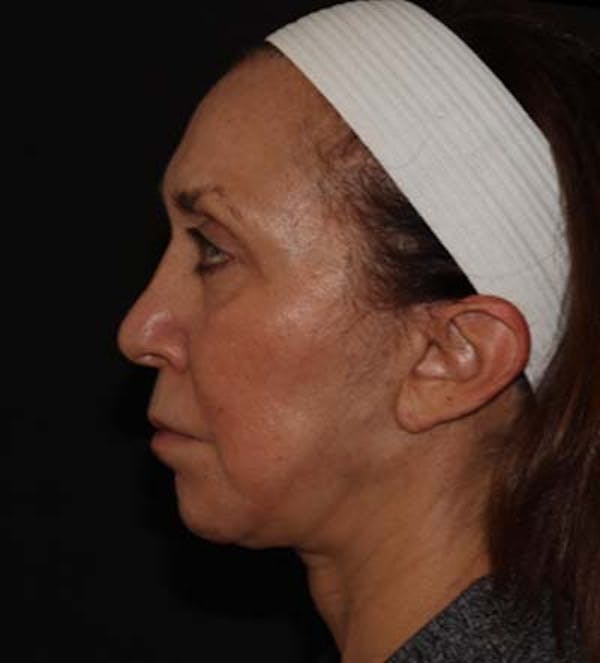  Blepharoplasty Before & After Gallery - Patient 121670069 - Image 4