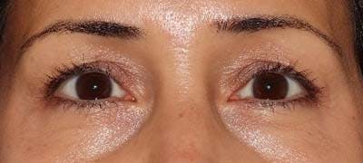 Before and After Eyelid Surgery