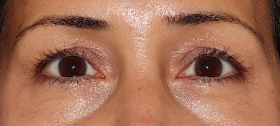  Blepharoplasty Before & After Gallery - Patient 121694118 - Image 1