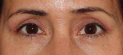  Blepharoplasty Before & After Gallery - Patient 121694118 - Image 2