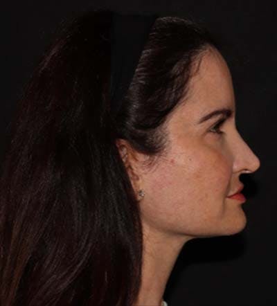 Facelift Before & After Gallery - Patient 121763167 - Image 3
