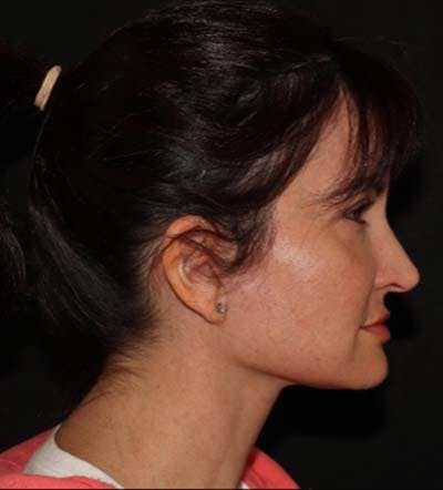 Facelift Before & After Gallery - Patient 121763167 - Image 4