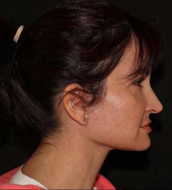 Facelift Before & After Gallery - Patient 121763167 - Image 4