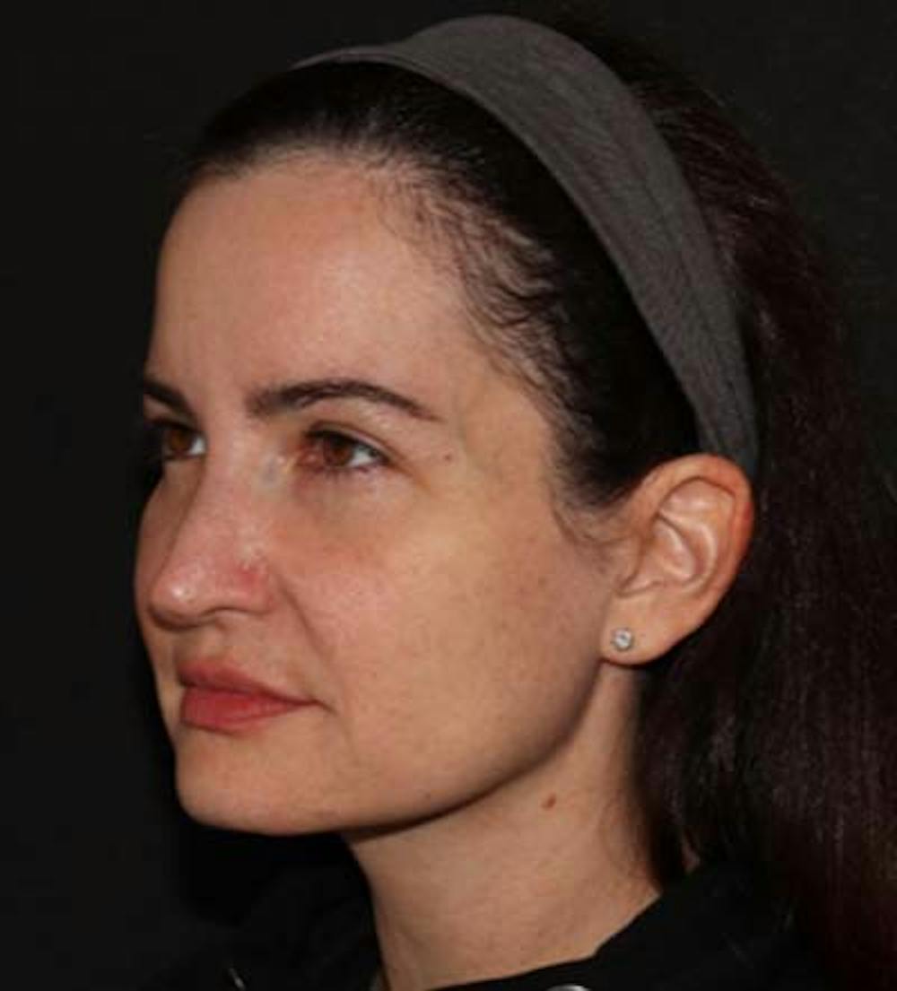 Facelift Before & After Gallery - Patient 121763167 - Image 5